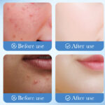 Sd79732 Tea Tree Invisible  Acne Removal  Patch (Sdo) - Image 2
