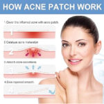 Sd79732 Tea Tree Invisible  Acne Removal  Patch (Sdo) - Image 3